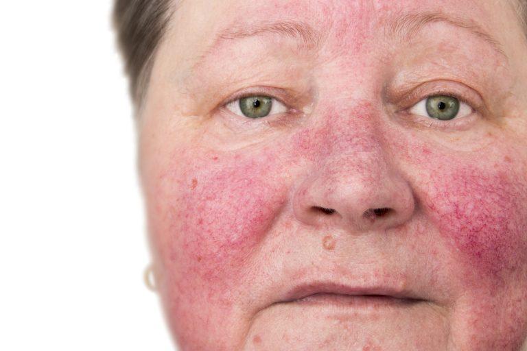 Acne Rosacea ( Rosacea, A. R. ) 