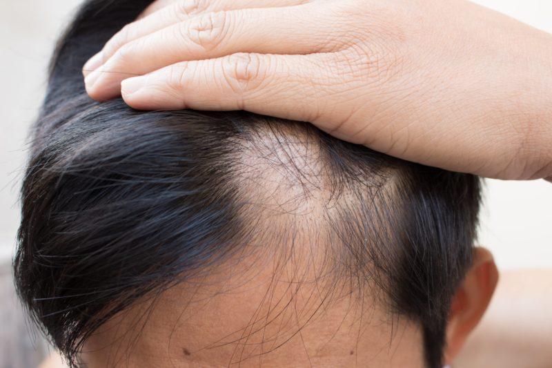 ALOPESİ AREATA ( SAÇKIRAN ) 