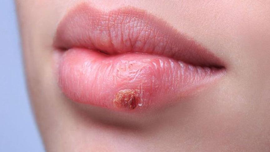 UÇUK ( HERPES ) 